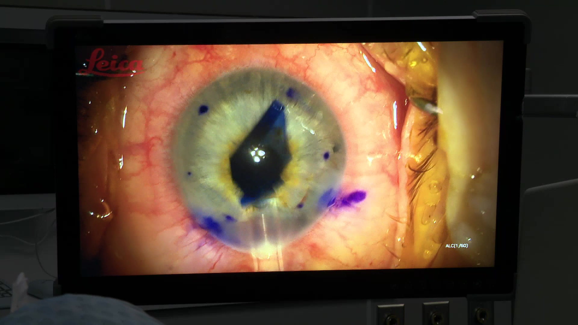 A Luxembourg first: A Luxembourg first: 30 cornea transplants in 2025